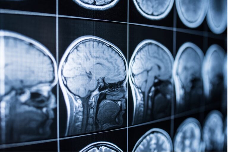 Brain Injury Cases