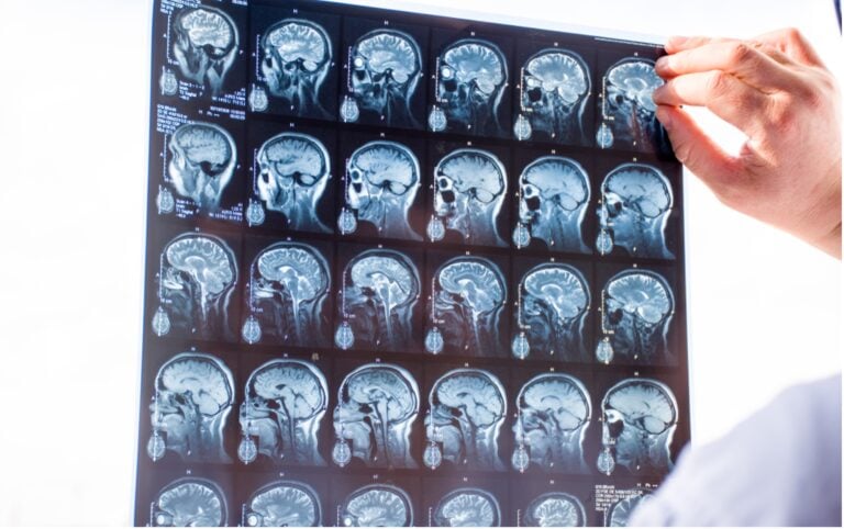 Traumatic Brain Injury Cases